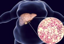 Nonalcoholic Fatty Liver Disease: Early Detection And Lifestyle Management
